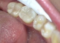 Bolesti zuba 4